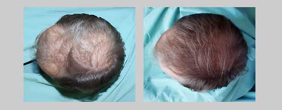 Eucapil Four Months Care – Fluridil – Hair Loss Treatment – Eucapil Shop