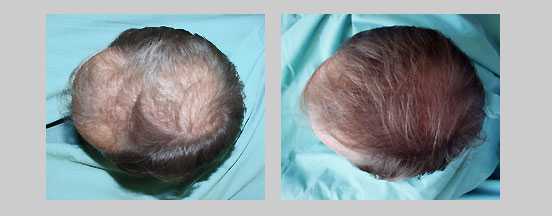 Hair loss